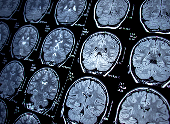 MRI Imaging